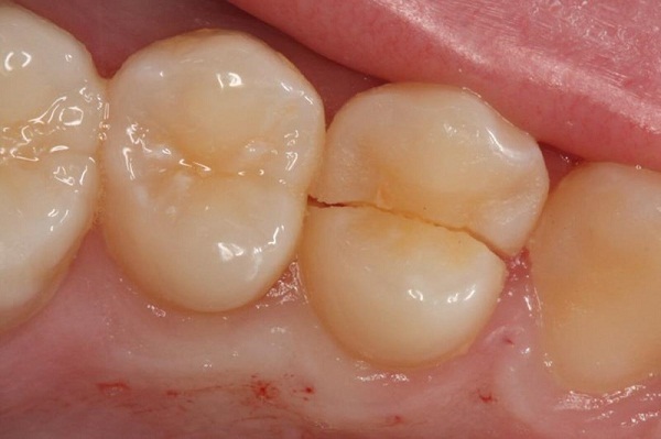 răng bị nứt có trám được không, răng bị nứt có lành lại không, răng bị nứt chân phải làm sao, vết trám răng bị nứt, cách chữa răng bị nứt, hiện tượng răng bị nứt nên làm gì, răng bị nứt, răng bị nứt có tự lành, răng bị nứt nhẹ, răng bị nứt vỡ, răng bị nứt đôi, tại sao răng bị nứt, răng bị nứt có sao không, răng bị nứt phải làm sao, răng bị nứt có trám được không, răng bị nứt chân, răng bị nứt có lành lại không, răng bị nứt nẻ, răng bị nứt làm sao, răng bị rạn nứt, chân răng bị nứt, xử lý răng bị nứt, cách điều trị răng bị nứt, cách khắc phục răng bị nứt, nguyên nhân răng bị nứt, nứt răng, răng bị nứt dọc, nứt dọc thân răng, răng nứt phải làm sao, răng hàm bị nứt đôi
