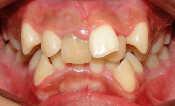 răng lòi xỉ, răng lòi xỉ có nhổ được không, răng lòi xỉ là gì, niềng răng lòi xỉ, hình răng lòi xỉ, hình ảnh răng lòi xỉ, nhổ răng lòi xỉ, bọc răng sứ cho răng lòi xỉ, răng bị lòi xỉ, răng lòi xỉ phải làm sao, răng lòi xỉ gây ảnh hưởng gì không, làm gì sau khi nhổ răng lòi xỉ,điều trị răng lòi xỉ, răng lòi xỉ có nguy hiểm không, nguyên nhân bị răng lòi xỉ, răng khểnh và răng lòi xỉ, nhổ răng lòi xỉ, niềng răng lòi xỉ, răng cửa lòi xỉ, nhổ răng lồi xỉ, hình ảnh răng lồi xỉ
