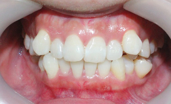 răng lòi xỉ, răng lòi xỉ có nhổ được không, răng lòi xỉ là gì, niềng răng lòi xỉ, hình răng lòi xỉ, hình ảnh răng lòi xỉ, nhổ răng lòi xỉ, bọc răng sứ cho răng lòi xỉ, răng bị lòi xỉ, răng lòi xỉ phải làm sao, răng lòi xỉ gây ảnh hưởng gì không, làm gì sau khi nhổ răng lòi xỉ,điều trị răng lòi xỉ, răng lòi xỉ có nguy hiểm không, nguyên nhân bị răng lòi xỉ, răng khểnh và răng lòi xỉ, nhổ răng lòi xỉ, niềng răng lòi xỉ, răng cửa lòi xỉ, nhổ răng lồi xỉ, hình ảnh răng lồi xỉ