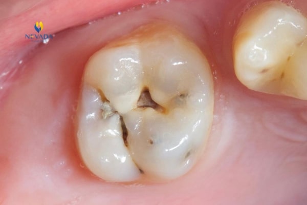 răng sâu nhiều có bọc sứ được không, răng sâu nặng có bọc sứ được không, răng sâu có thể bọc sứ được không, răng sâu có nên bọc sứ, răng sâu có bọc sứ được không, răng bị sâu có bọc sứ được không, quy trình bọc răng sứ cho răng sâu, có nên bọc răng sứ cho răng sâu, chi phí bọc răng sứ cho răng sâu, bọc sứ răng sâu bao nhiêu tiền, bọc sứ cho răng sâu, bọc răng sứ răng sâu, bọc răng sứ có bị sâu răng không, bọc răng sứ cho răng sâu bao nhiêu tiền, bọc răng sứ cho răng sâu, bọc răng sứ cho răng hàm sâu