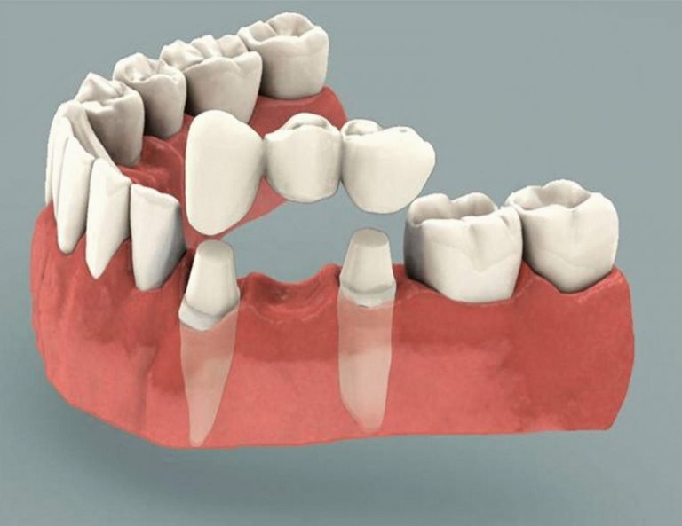 phương pháp trồng răng cấm có đau không 2