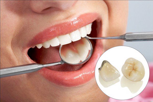 bọc răng sứ cho răng cửa bị mẻ, bọc răng sứ cho răng bị mẻ, bọc răng sứ 2 răng cửa bị mẻ, bọc sứ răng cửa bị mẻ, phục hồi răng mẻ, Răng cửa bị mẻ phải làm sao