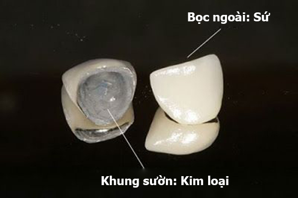 ưu nhược điểm của răng sứ kim loại, nhược điểm của răng sứ kim loại, ưu điểm của bọc răng sứ kim loại, ưu và nhược điểm của bọc răng sứ kim loại