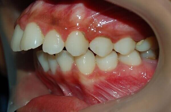 Hàm răng xấu phải làm sao?