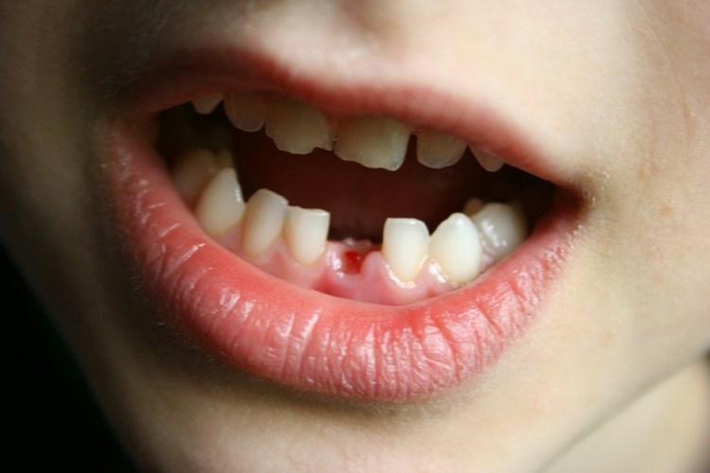 Lứa tuổi thay răng sữa và mọc răng vĩnh viễn ở trẻ, tuổi thay răng sữa, mấy tuổi thay răng sữa, thay răng sữa ở trẻ, trẻ em thay răng sữa lúc mấy tuổi, trình tự thay răng sữa