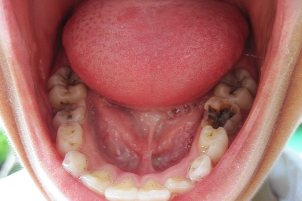 cao răng huyết thanh,cao răng huyết thanh là gì,sự hình thành cao răng,vôi răng huyết thanh,cao răng huyết thanh và cao răng nước bọt