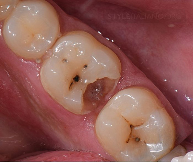 cách loại bỏ chấm đen trên răng, loại bỏ chấm đen trên răng, cách làm hết chấm đen trên răng, làm sao để loại bỏ chấm đen trên răng