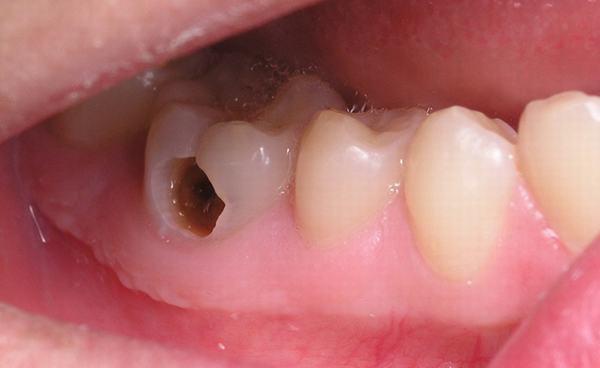niềng răng bị hỏng, niềng răng hỏng, dấu hiệu niềng răng hỏng, những ca niềng răng hỏng, những ca niềng răng bị hỏng, Niềng răng không thành công