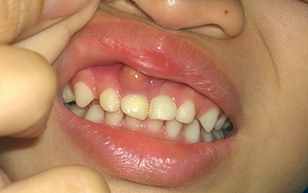 viêm nướu răng trẻ em, điều trị viêm nướu răng trẻ em, nướu răng trẻ em, nướu răng bé bị sưng, viêm nướu răng ở trẻ em, thuốc điều trị viêm nướu răng ở trẻ em, bị sưng nướu răng ở trẻ, trẻ bị viêm nướu răng uống thuốc gì, trẻ bị viêm lợi và sốt, trẻ bị nổi cục ở lợi
