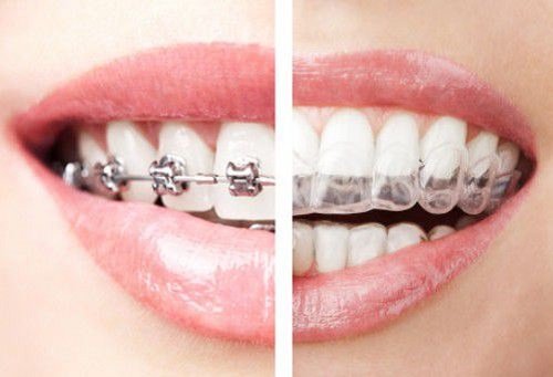 Chi phí niềng răng hô hàm trên bao nhiêu tiền, Niềng răng hô hàm trên bao nhiêu tiền, chi phí niềng răng hô hàm trên