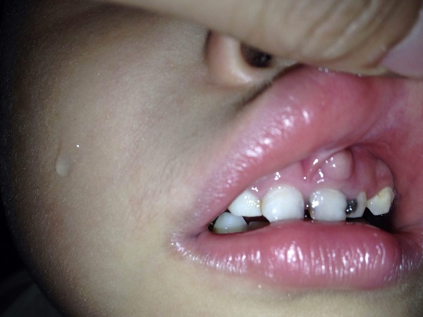 nổi mụn trắng ở nướu răng trẻ sơ sinh, nổi mụn trắng ở nướu răng, nổi mụn ở nướu răng, nổi mụn nước ở nướu răng, nổi mụn thịt ở nướu răng, nổi mụn mủ ở nướu răng, mọc mụn trắng ở lợi