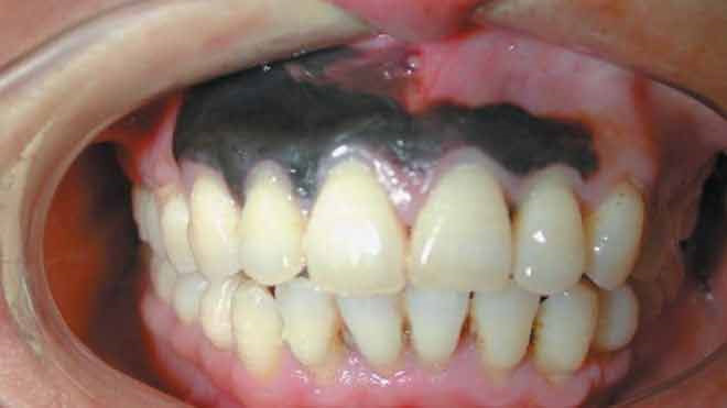 Nướu răng bị sưng không đau, nướu răng bị sưng, sưng nướu răng, không đau, đen, đỏ, cứng, to