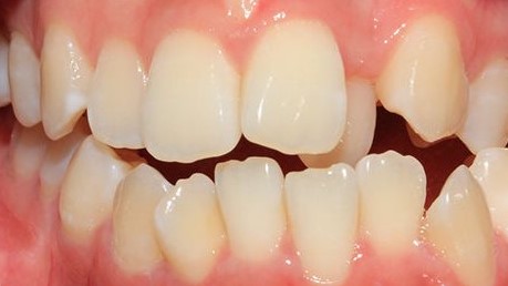 răng mọc không đều phải làm sao, răng mọc không đều cách chữa, răng mọc không đều phẫu thuật, răng trẻ mọc không đều, niềng răng mọc không đều, hàm răng mọc không đều, tại sao răng mọc không đều, nguyên nhân răng mọc không đều, hình ảnh răng mọc không đều, chỉnh hình răng mọc không đều