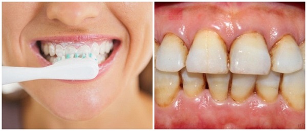 Tại sao răng vàng ố và có cao răng?