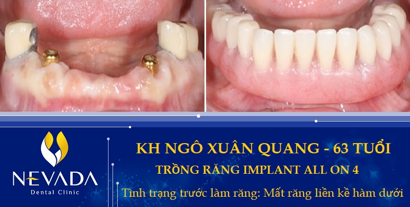 Trồng răng implant trả góp, Có nên trồng răng implant trả góp, trồng răng implant trả góp, có nên trồng răng implant trả góp, trồng răng implant trả góp ở đâu tốt, trồng răng implant trả góp tphcm, trồng răng implant trả góp tại hà nội