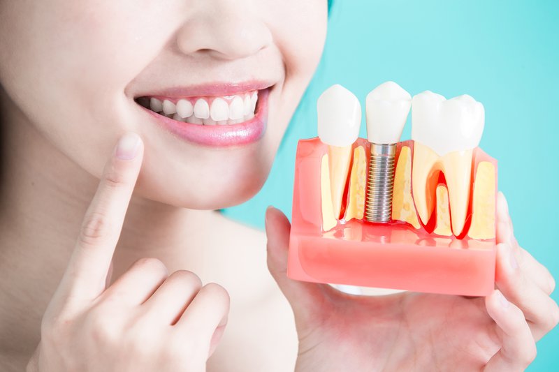 Trồng răng implant ở đâu tốt tphcm, Trồng răng implant ở đâu tphcm, cấy ghép răng implant, làm răng implant