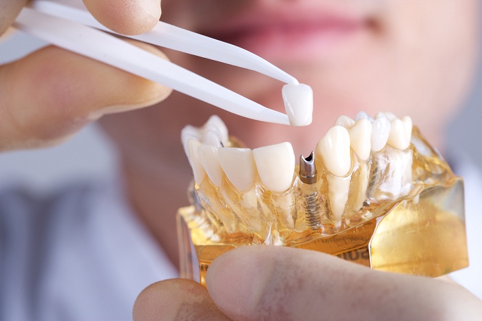 Trồng răng implant, Trồng răng implant ở đâu tốt tphcm, Trồng răng implant ở đâu tphcm, cấy ghép răng implant, làm răng implant, trồng, implant, răng, ở đâu, tốt, tphcm 