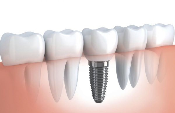 Trồng răng implant có đau không, trồng răng implant có đau không webtretho, trồng răng implant có đau không,trồng răng implant có đau không webtretho,trồng răng bằng phương pháp implant có đau không,trồng răng implant có đau,trồng răng sứ implant có đau không,trồng răng giả implant có đau không
