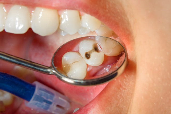 viêm tủy răng cấp tính, viêm tủy răng cấp, điều trị viêm tủy răng cấp, triệu chứng viêm tủy răng cấp, cách chữa viêm tủy răng cấp, viêm tủy răng cấp là gì, chữa viêm tủy răng cấp, bệnh án viêm tủy răng cấp, triệu chứng viêm tủy răng cấp tính