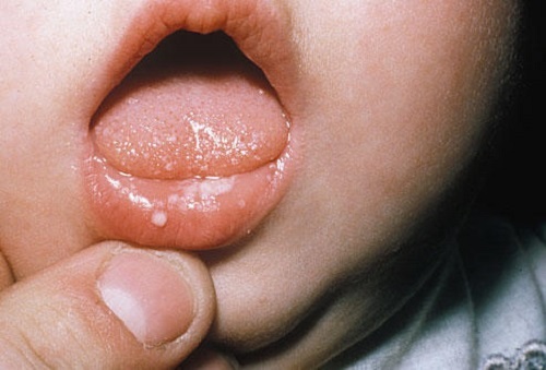trẻ bị cam miệng kiêng ăn gì, cách chữa cam miệng ở trẻ sơ sinh, cách chữa bệnh cam miệng ở trẻ em, cách điều trị bệnh cam miệng ở trẻ em, cách chữa bệnh cam lưỡi