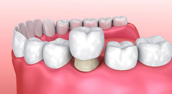 cách phục hồi răng sâu, phục hồi răng sâu, phục hồi răng sâu tại nhà, tự phục hồi răng sâu, cách phục hồi răng bị sâu