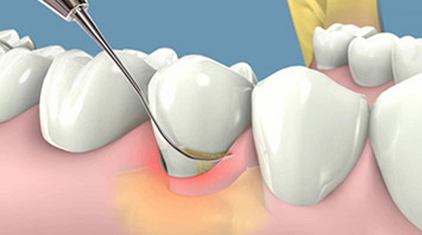 chữa ê buốt răng sau khi lấy cao răng, bị ê răng sau khi lấy cao răng, răng bị ê buốt sau khi lấy cao răng, cách giảm ê buốt răng sau khi lấy cao răng