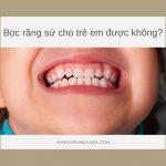 Có nên bọc răng sứ cho trẻ em? Lưu ý về độ tuổi bọc răng sứ