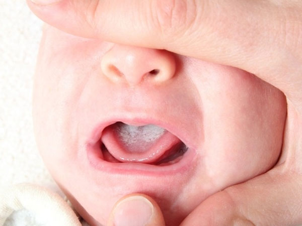 hình ảnh nhiệt miệng ở trẻ em, hình ảnh nhiệt miệng ở trẻ, hình ảnh nhiệt miệng ở trẻ sơ sinh, hình ảnh nhiệt miệng ở trẻ nhỏ