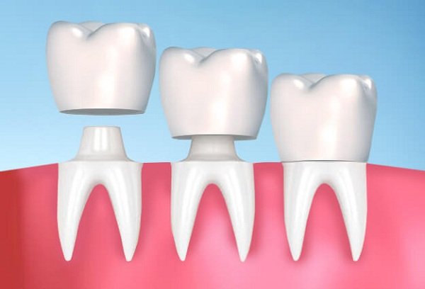 mòn men răng, răng bị mòn dần, nguyên nhân hỏng men răng, dấu hiệu mòn răng, răng bị mòn mặt nhai, cách chữa trị mòn cổ răng 