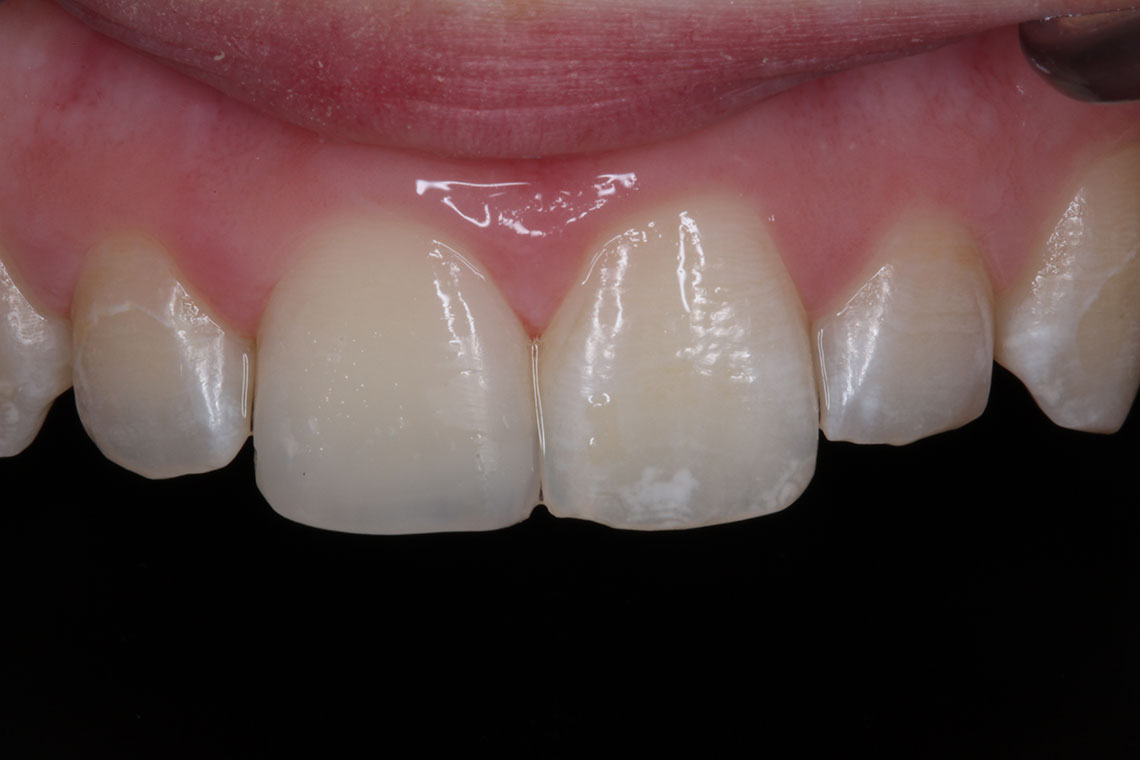 mòn men răng, răng bị mòn dần, nguyên nhân hỏng men răng, dấu hiệu mòn răng, răng bị mòn mặt nhai, cách chữa trị mòn cổ răng 