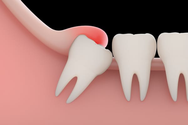 nhổ răng có ảnh hưởng đến thần kinh, nhổ răng có ảnh hưởng đến thần kinh không, nhổ răng có ảnh hưởng đến dây thần kinh không, nhổ răng có ảnh hưởng thần kinh không