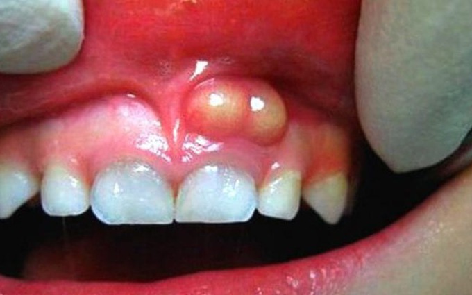 răng không sâu nhưng đau, răng không bị sâu nhưng đau, đau răng không rõ nguyên nhân, đau răng không bị sâu, răng không bị sâu mà đau