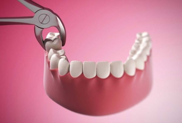 , răng mọc lệch hàm trên, răng khôn mọc lệch hàm trên, răng cửa mọc lệch hàm trên, nhổ răng mọc lệch hàm trên, nhổ răng khôn mọc lệch hàm trên, răng khôn mọc lệch ở hàm trên, răng khôn mọc lệch ra má hàm trên, răng hàm trên mọc lệch vào trong, răng cửa hàm trên mọc lệch vào trong, răng số 8 hàm trên mọc lệch
