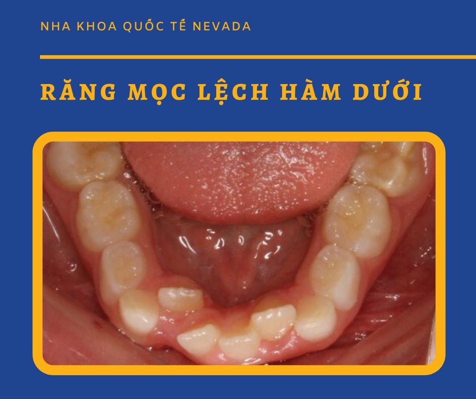 răng mọc lệch hàm dưới, răng khôn mọc lệch hàm dưới, răng khôn mọc lệch hàm dưới có nên nhổ không, nhổ răng mọc lệch hàm dưới, nhổ răng khôn mọc lệch hàm dưới, nhổ răng khôn mọc lệch hàm dưới có đau không, răng khôn mọc lệch ra má hàm dưới, răng hàm dưới mọc lệch vào trong, răng hàm dưới mọc lệch ra ngoài, răng cửa hàm dưới mọc lệch vào trong