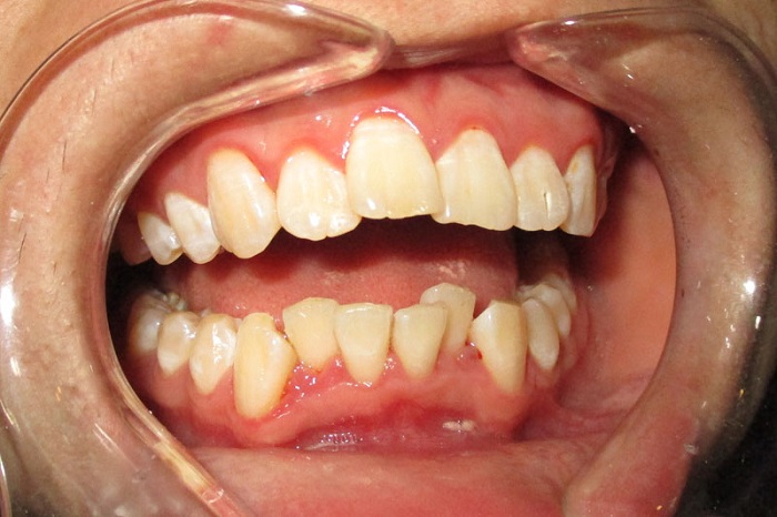 răng mọc lệch hàm dưới, răng khôn mọc lệch hàm dưới, răng khôn mọc lệch hàm dưới có nên nhổ không, nhổ răng mọc lệch hàm dưới, nhổ răng khôn mọc lệch hàm dưới, nhổ răng khôn mọc lệch hàm dưới có đau không, răng khôn mọc lệch ra má hàm dưới, răng hàm dưới mọc lệch vào trong, răng hàm dưới mọc lệch ra ngoài, răng cửa hàm dưới mọc lệch vào trong