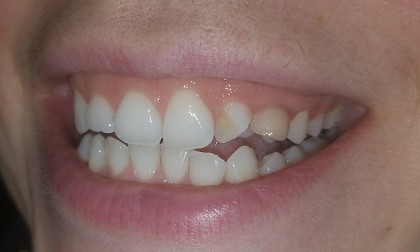 răng ngắn, răng ngắn phải làm sao, răng nhỏ ngắn, răng dài răng ngắn