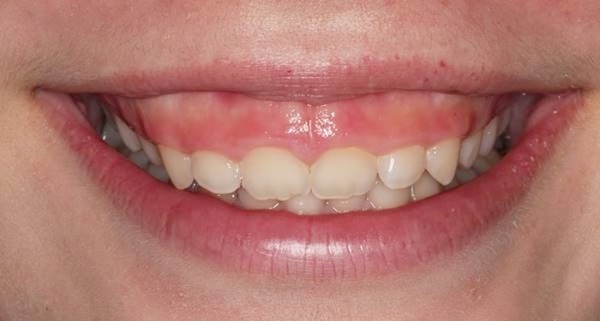 răng ngắn, răng ngắn phải làm sao, răng nhỏ ngắn, răng dài răng ngắn