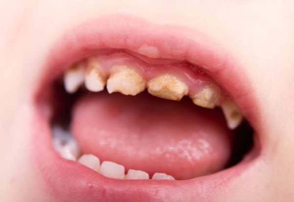 răng trẻ 1 tuổi bị ố vàng, răng trẻ 1 tuổi bị vàng, răng bé 1 tuổi bị vàng