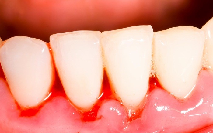 răng yếu, răng yếu phải làm sao, răng yếu lung lay, răng yếu có niềng được không, răng yếu ăn gì, răng yếu nên làm gì, răng yếu nên ăn gì, răng yếu là thiếu chất gì, răng yếu dễ vỡ, răng yếu bị lung lay, răng yếu sau khi sinh, răng yếu sau niềng, răng yếu nên bổ sung gì