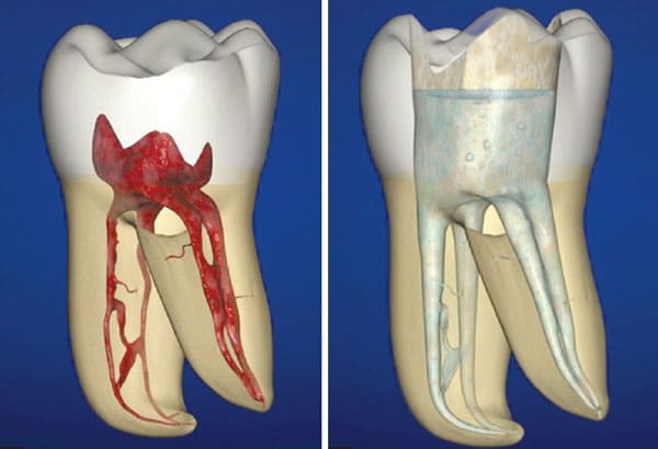 cách lấy tủy răng không đau