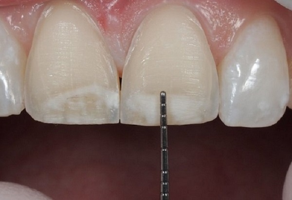 bọc răng sứ cho răng không đều, bọc răng sứ cho răng mọc không đều, bọc răng sứ răng không đều