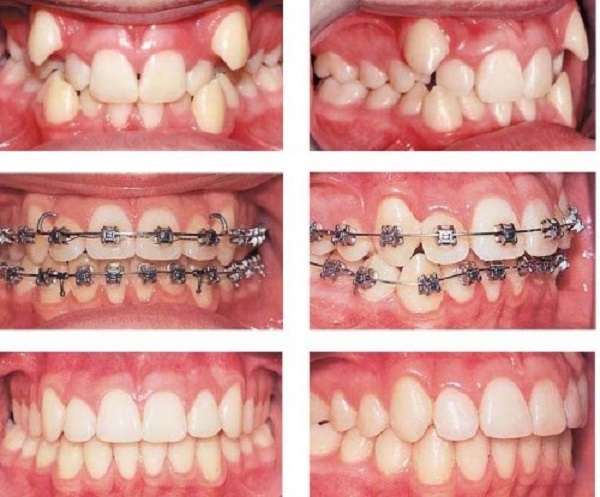 bọc răng sứ cho răng không đều, bọc răng sứ cho răng mọc không đều, bọc răng sứ răng không đều