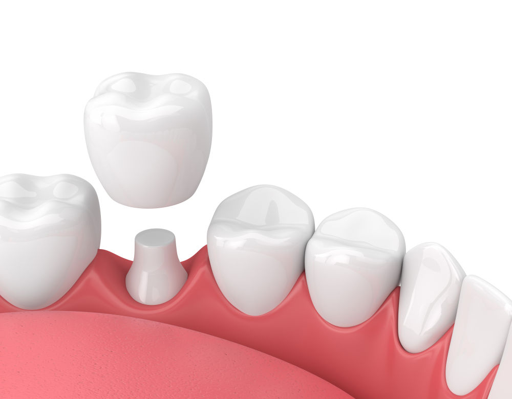 tác dụng bọc răng sứ, bọc răng sứ có tác dụng gì, tác dụng của bọc răng sứ