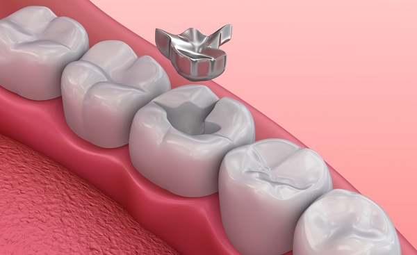 trám răng amalgam, chất trám răng amalgam, giá trám răng amalgam, có nên trám răng amalgam
