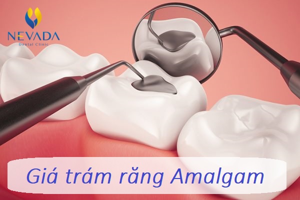 trám răng amalgam, chất trám răng amalgam, giá trám răng amalgam, có nên trám răng amalgam