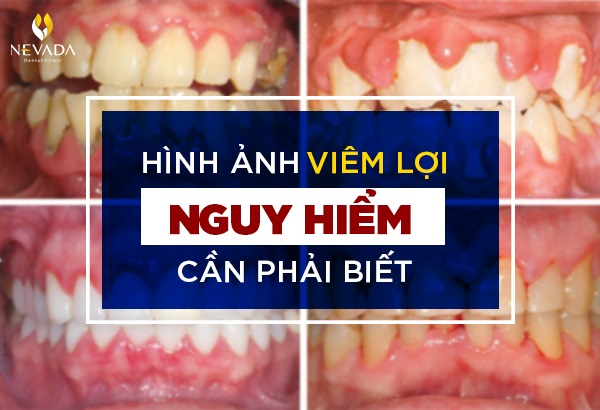 Hình ảnh viêm lợi - Chứng bệnh tiềm ẩn nhiều nguy hiểm bạn cần biết