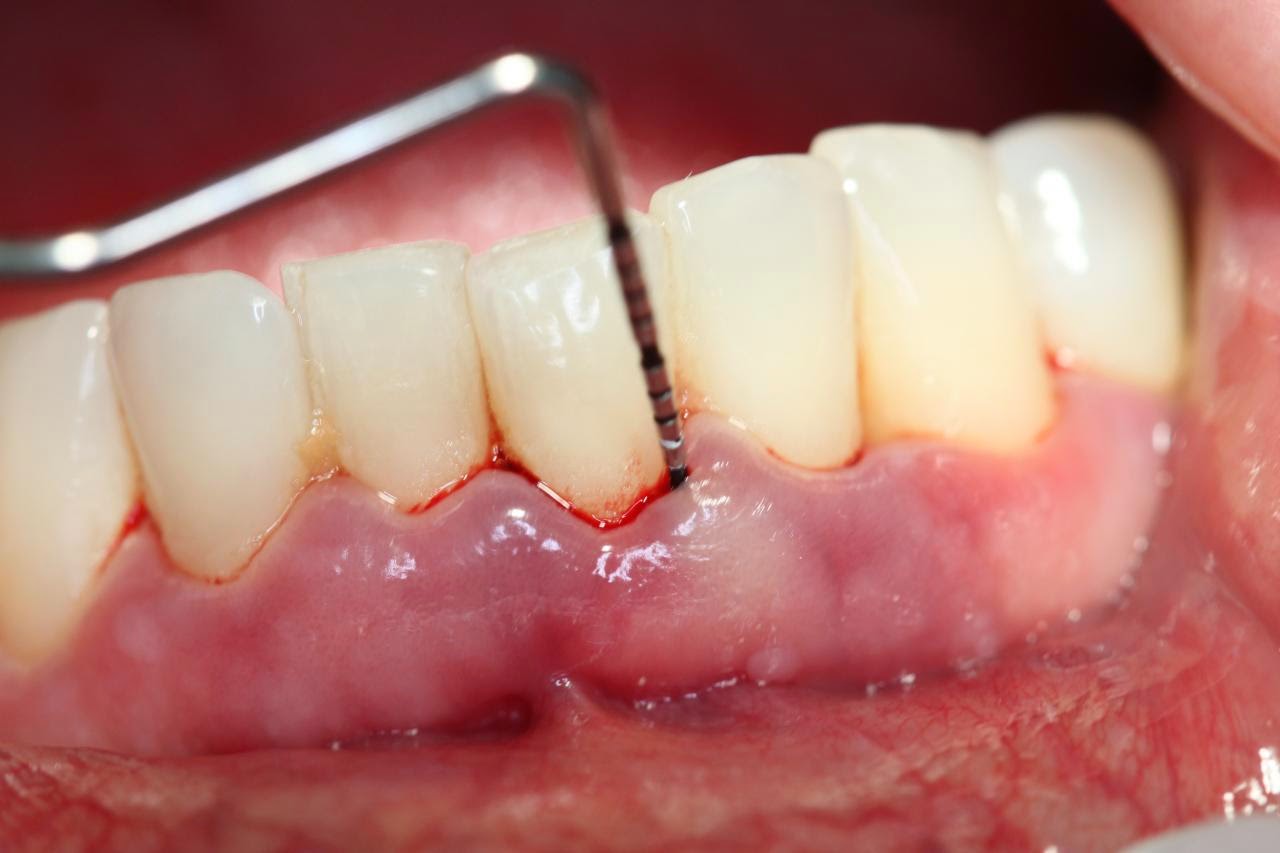 hình ảnh viêm nướu răng, hình ảnh viêm lợi răng, hình ảnh bệnh viêm nướu răng