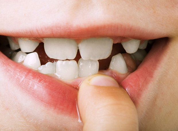 hình ảnh viêm nướu răng, hình ảnh viêm lợi răng, hình ảnh bệnh viêm nướu răng