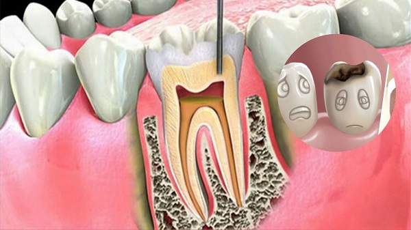 hút tủy răng đau cỡ nào, lấy tủy răng có đau không webtretho, lấy tủy răng sâu có đau không, review lấy tủy răng có đau không
