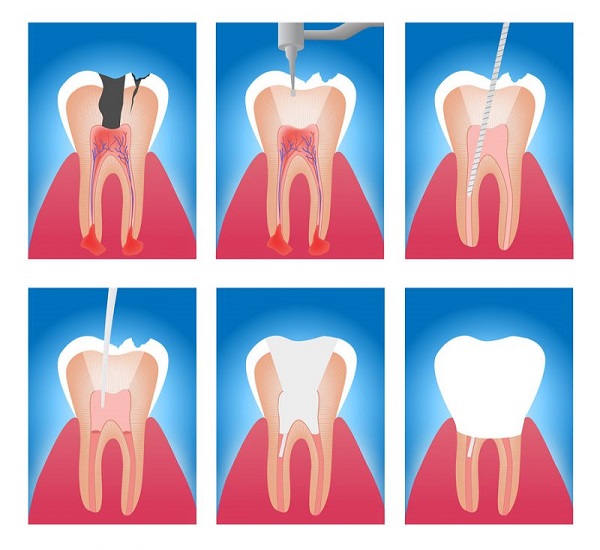 lấy tủy răng xong bị đau, lấy tuỷ răng xong có bị đau không, sau khi lấy tủy răng có đau không, triệu chứng sau khi lấy tuỷ răng